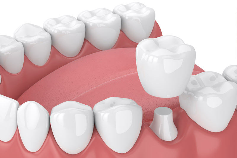 Dental Crowns in Lakeview & Lincoln Square