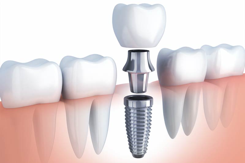 Implants Dentist in Lakeview & Lincoln Square