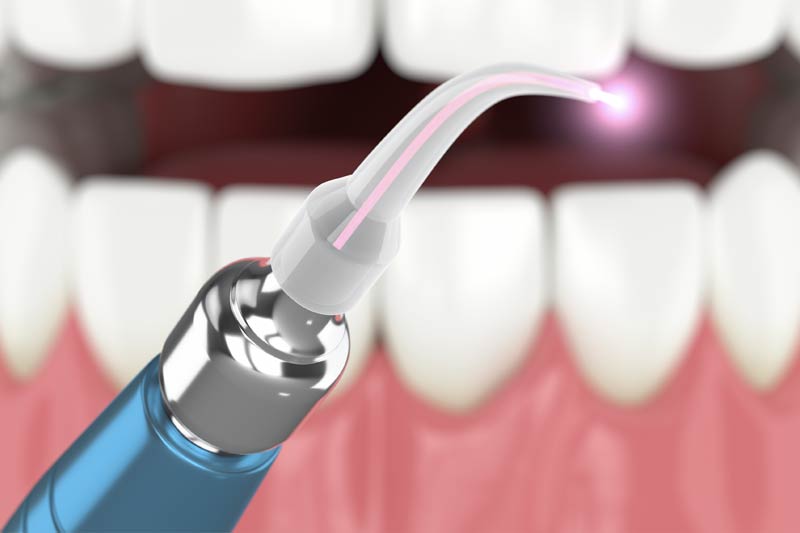 Laser Dentistry in Lakeview & Lincoln Square