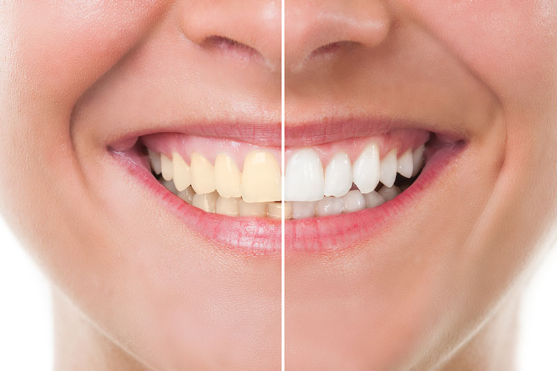 Teeth Whitening in Lakeview & Lincoln Square
