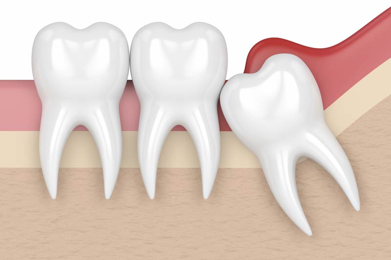 Wisdom Tooth Removal in Lakeview & Lincoln Square